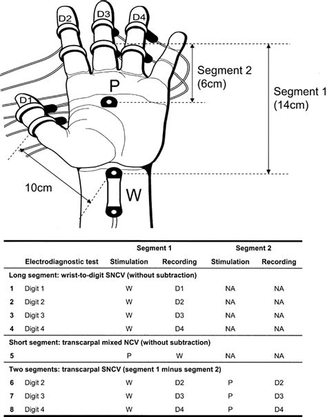 carpal tunnel sensitivity chart